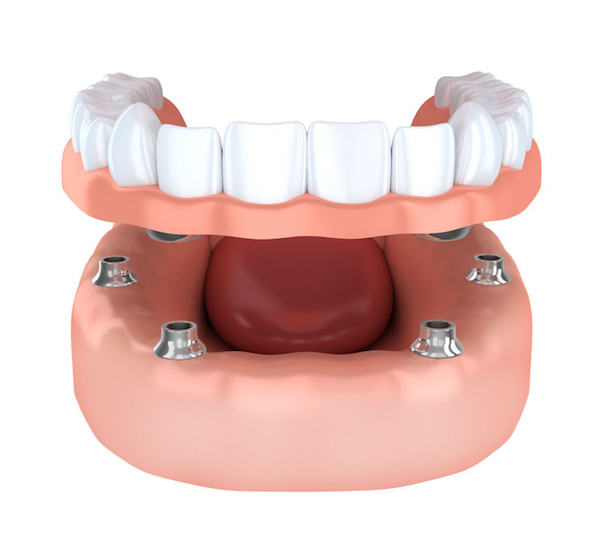 dental-implants-in-gurgaon-at-dental-centre-india