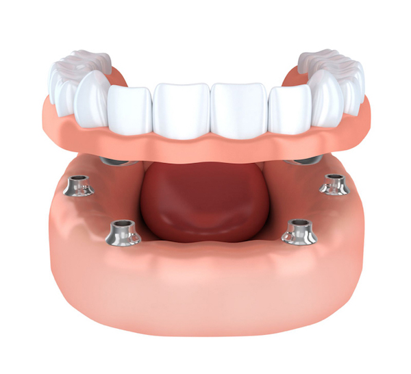dental-implants-in-gurgaon