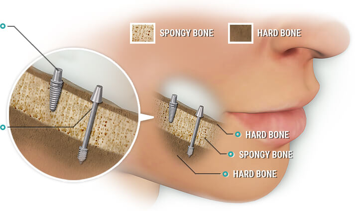 Sinus Lift - Bone Graft Treatment