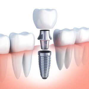 Single-dental-implants-in-gurgaon