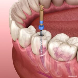 root-canal-treatment-in-gurgaon