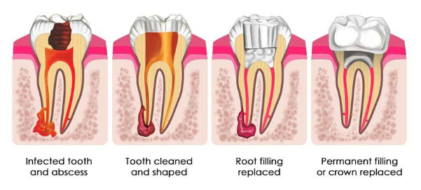 root-canal-treatment-in-gurgaon