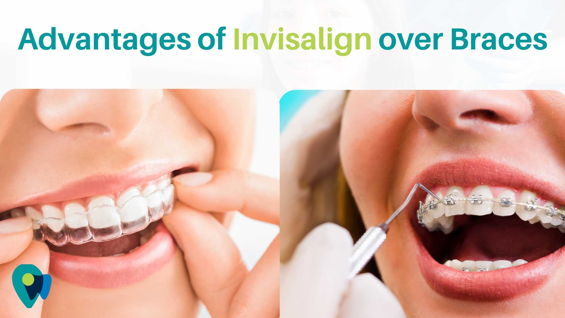 Read more about the article Advantages of Invisalign over Braces