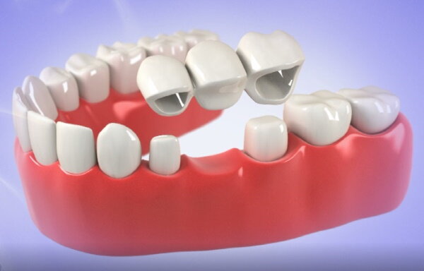 crowns & bridges dental centre india