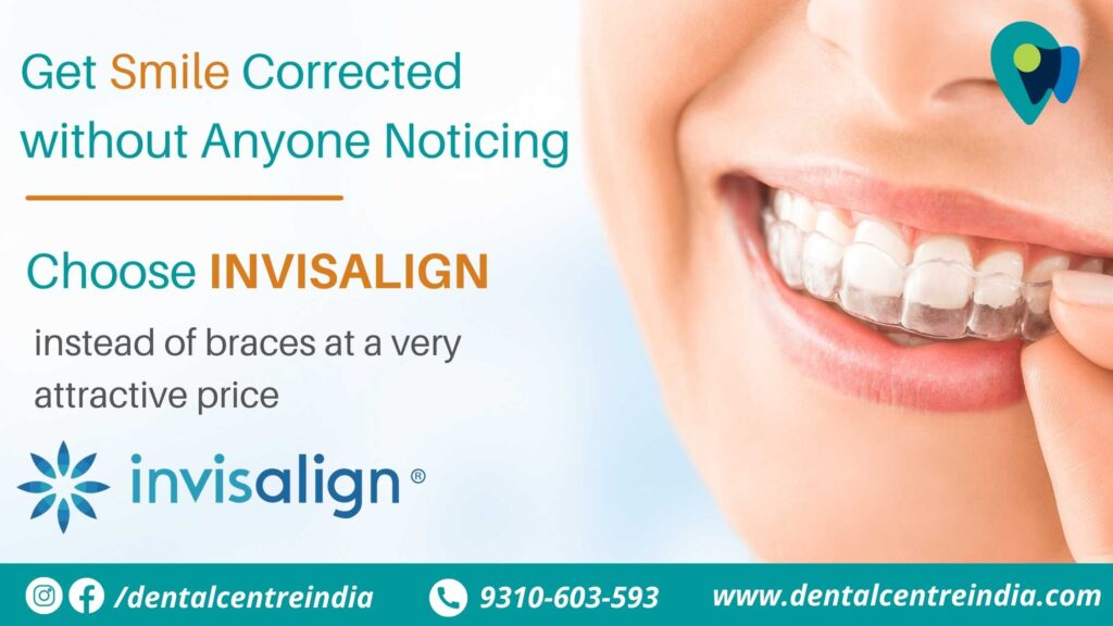 invisalign-cost-in-delhi-NCR