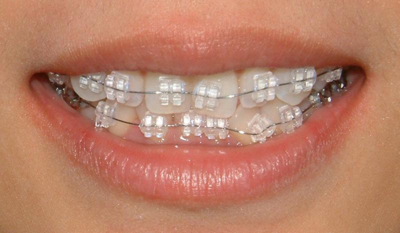 Traditional Braces Treatment in India | Traditional Braces Treatment near you