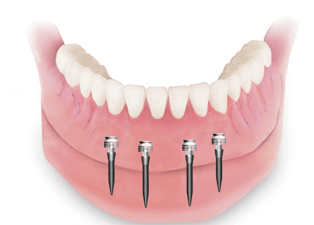 Denture Treatment in Dwarka