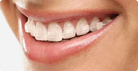 Traditional Braces Treatment in India | Traditional Braces Treatment near you