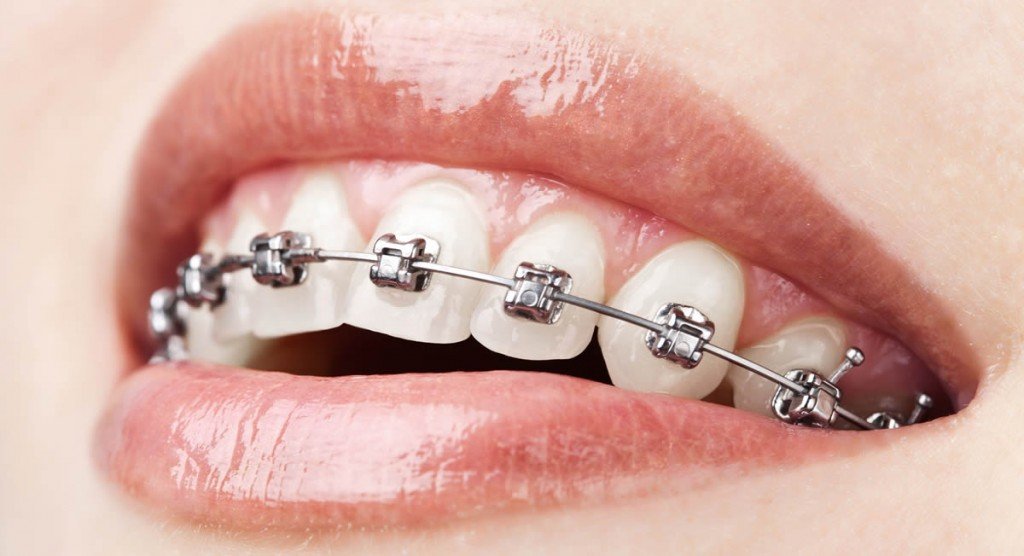 Traditional Braces Treatment in India | Traditional Braces Treatment near you