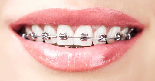 Traditional Braces Treatment in India | Traditional Braces Treatment near you