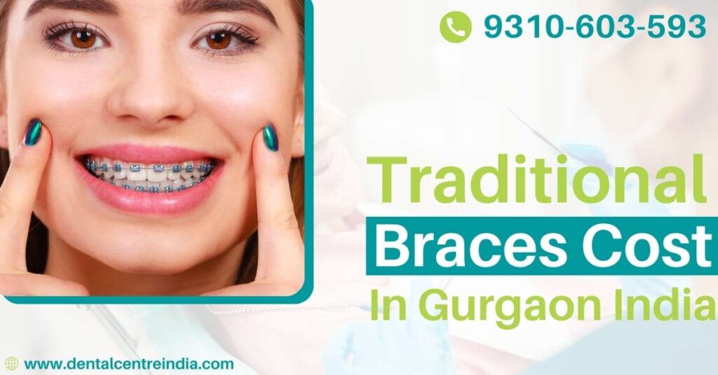 Traditional Braces Cost in Gurgaon