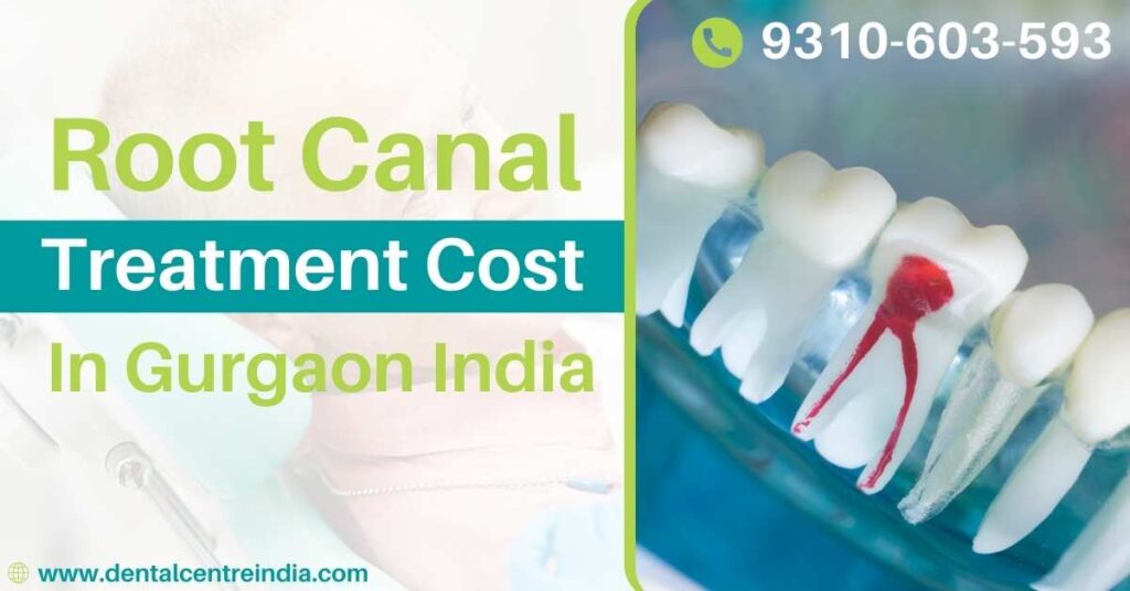 Root Canal Treatment Cost in Gurgaon, India