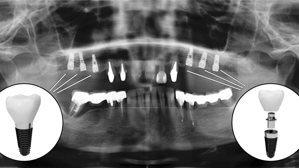 Dental-Implant-Cost-in-Gurgaon