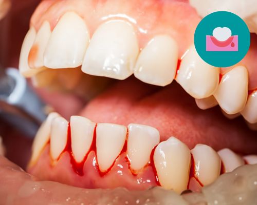 Dental Centre India Bleeding Gums