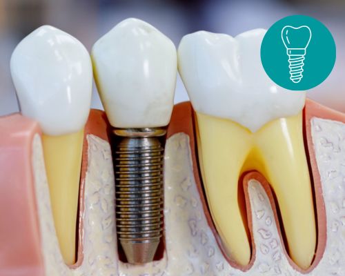 Dental Centre India Dental Implant