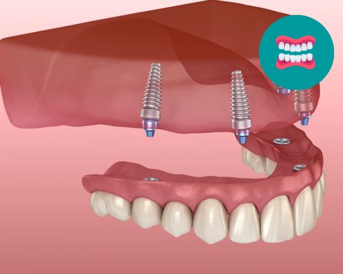 Dental Centre India Implant Supported Dentures