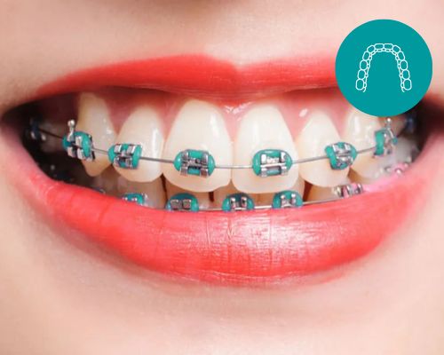 Dental Centre India Traditional Braces