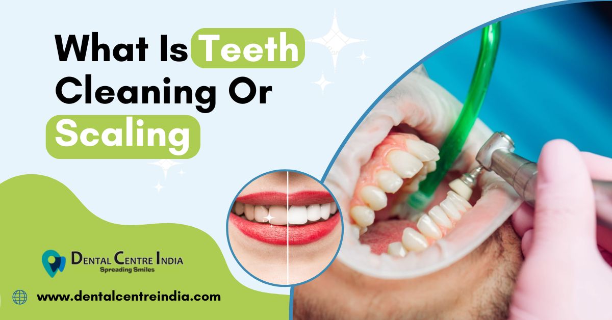 You are currently viewing What Is Teeth Cleaning Or Scaling