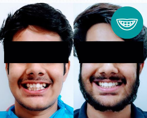 Smile Makeover