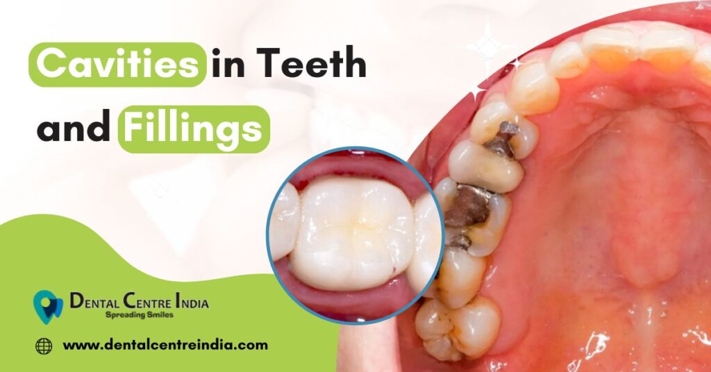 Cavities in Teeth and Fillings | Dentist in Gurgaon | Dental Clinic in Gurgaon