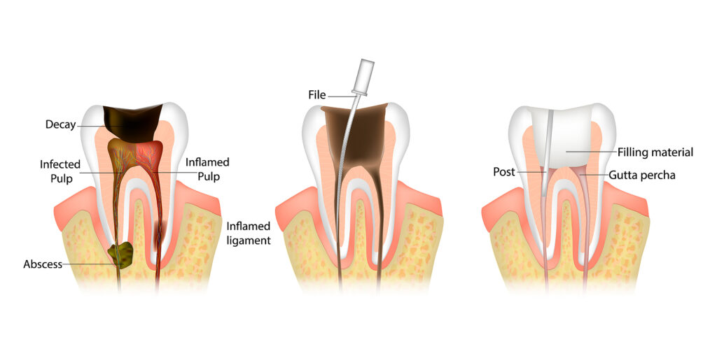 Pain-Free Root Canal Treatment: Dental Centre India - The Best Dental Clinic in Gurgaon