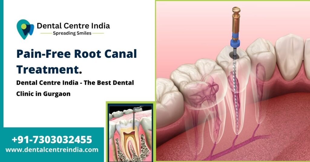 Pain-Free Root Canal Treatment | Dental Centre India | The Best Dental Clinic in Gurgaon