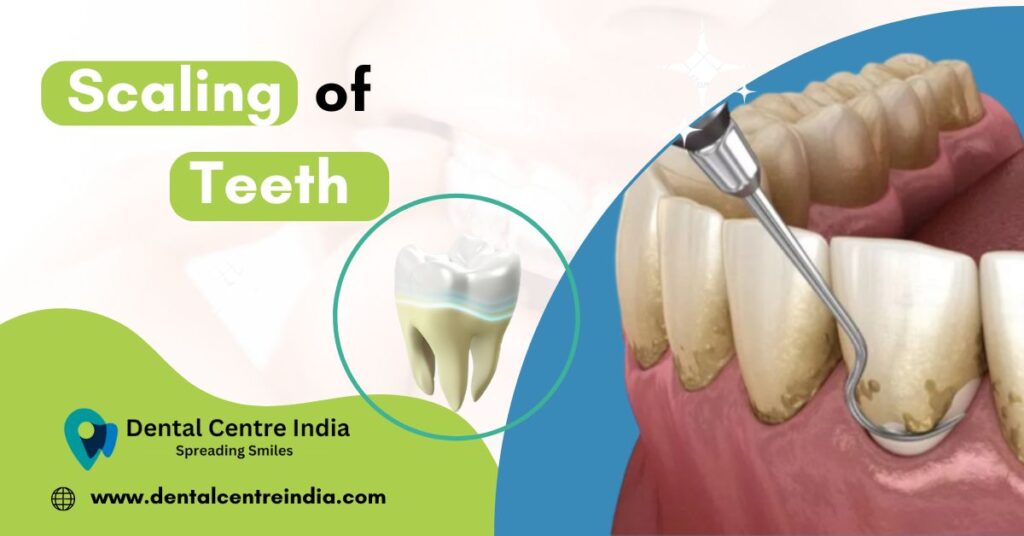 Scaling Of Teeth | Dental Centre India