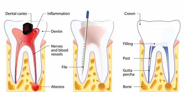 Pain-Free Root Canal Treatment: Dental Centre India - The Best Dental Clinic in Gurgaon